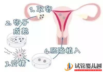 试管婴儿的一个基本流程和周期时间(图1) 试管婴儿的一个基本流程和周期时间(图1)