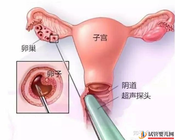 试管婴儿流程&费用(图3) 试管婴儿流程&费用(图3)