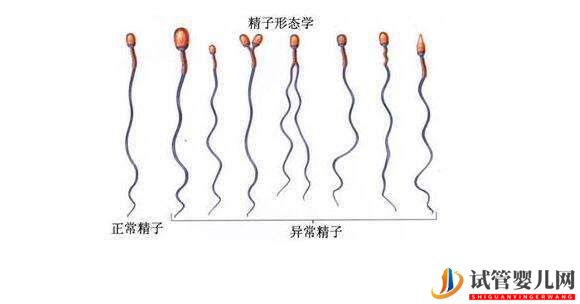 格鲁吉亚试管婴儿精子畸形可以做试管婴儿吗?(图1) 格鲁吉亚试管婴儿精子畸形可以做试管婴儿吗?(图1)
