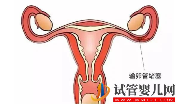 你了解输卵管阻塞吗?原因/症状/影响(图1) 你了解输卵管阻塞吗?原因/症状/影响(图1)