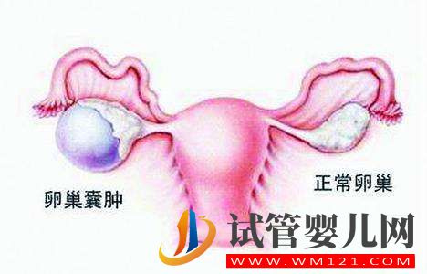 卵巢囊肿会引起卵巢衰退吗?(图1) 卵巢囊肿会引起卵巢衰退吗?(图1)