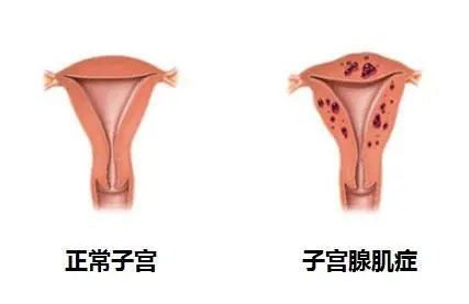 我有子宫腺肌症,可以做试管婴儿吗?(图1) 我有子宫腺肌症,可以做试管婴儿吗?(图1)