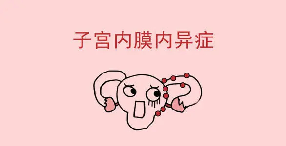 子宫内膜异位症,是卵巢癌的主要元凶?(图1) 子宫内膜异位症,是卵巢癌的主要元凶?(图1)