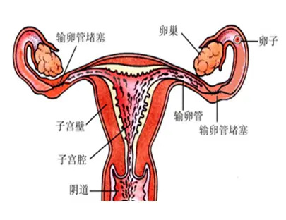 输卵管堵塞的原因是什么,能彻底根治吗?(图1) 输卵管堵塞的原因是什么,能彻底根治吗?(图1)