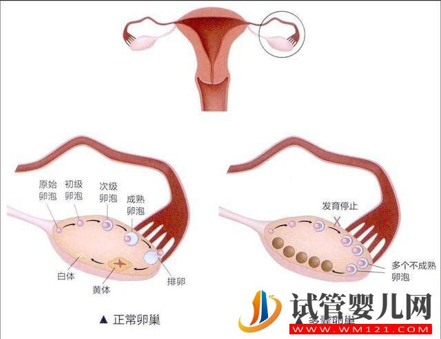 多囊卵巢综合征是怎样的一种疾病?(图1) 多囊卵巢综合征是怎样的一种疾病?(图1)