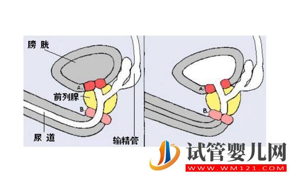 逆行射精可以做试管婴儿吗?(图1) 逆行射精可以做试管婴儿吗?(图1)