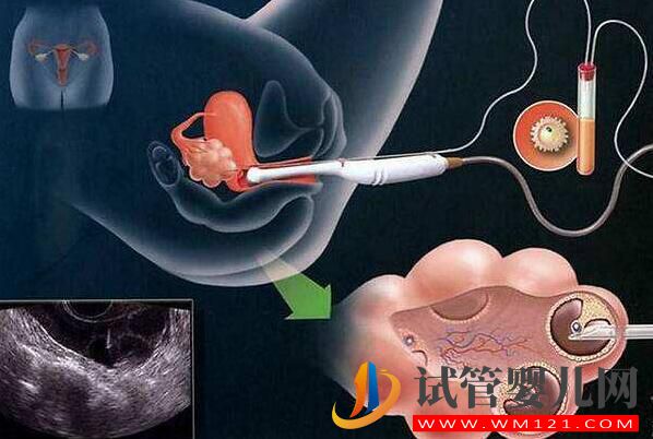 做试管婴儿取多少个卵子合适?(图1) 做试管婴儿取多少个卵子合适?(图1)