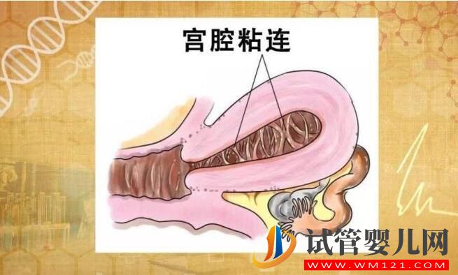 宫内粘连会影响到试管婴儿吗?(图1) 宫内粘连会影响到试管婴儿吗?(图1)