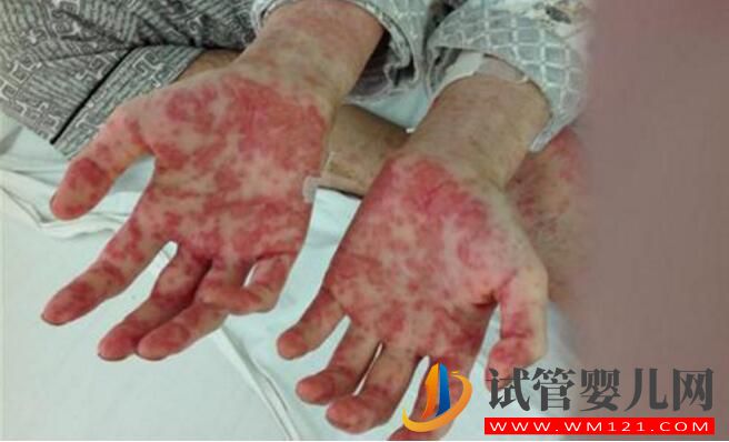 做试管婴儿真的容易得白血病吗?(图4) 做试管婴儿真的容易得白血病吗?(图4)