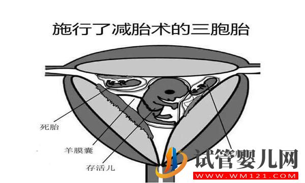 试管婴儿减胎术在哪些情况下使用 要注意哪些(图2) 试管婴儿减胎术在哪些情况下使用 要注意哪些(图2)