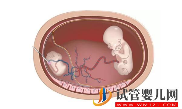 试管婴儿减胎术在哪些情况下使用 要注意哪些(图1) 试管婴儿减胎术在哪些情况下使用 要注意哪些(图1)