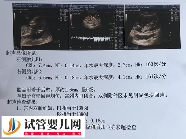 日本试管婴儿双胞胎几率有多大(图1)