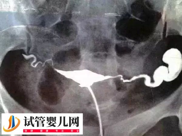 做试管输卵管积水有没有影响(图1)