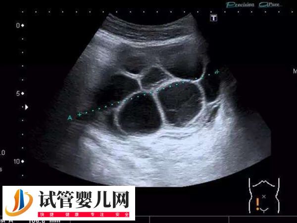移植完胚胎后为什么腹水