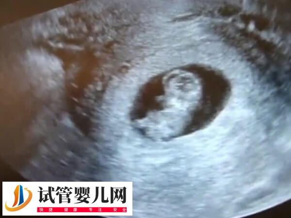 试管婴儿检查NT会不会有问题(图1)