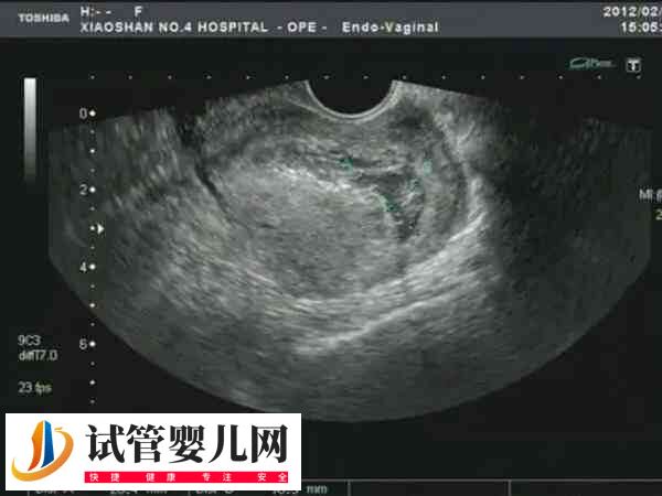子宫切除手术危害大不大(图4)