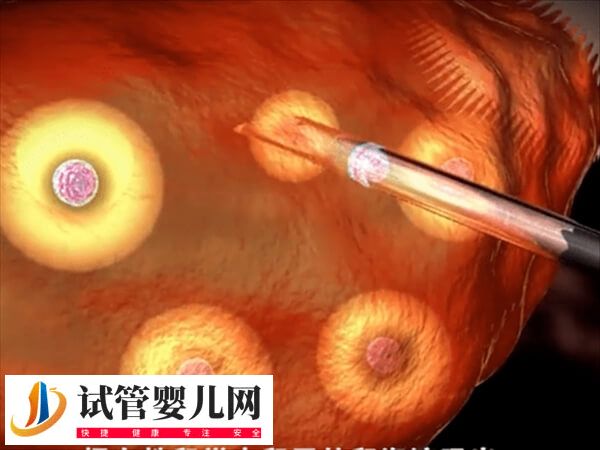 52岁女性绝经能不能做试管婴儿(图1) 52岁女性绝经能不能做试管婴儿(图1)