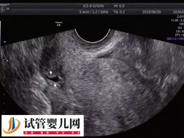 子宫憩室影不影响试管移植(图1)