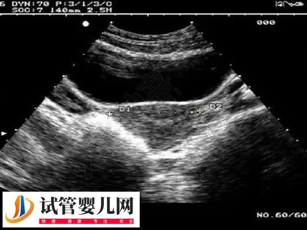 降低试管婴儿妊娠率的疾病有哪些(图2)