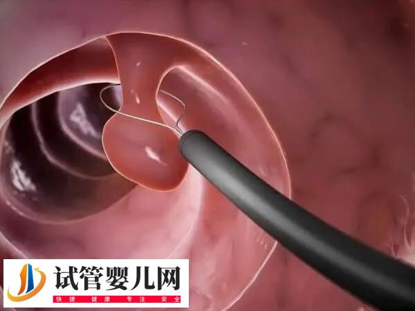 子宫内膜息肉怎么治疗(图1)