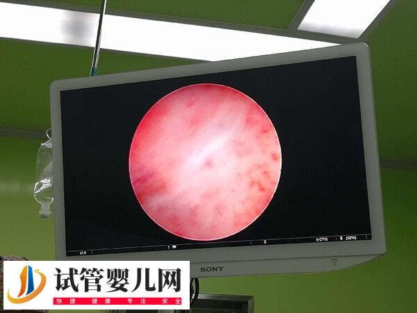 宫腔镜刮诊后多久能做试管婴儿(图1)