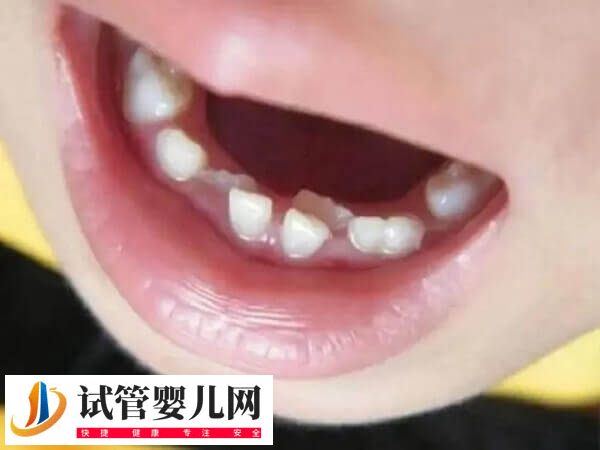 孩子地包天是什么原因导致的