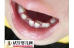 孩子地包天是什么原因导致的